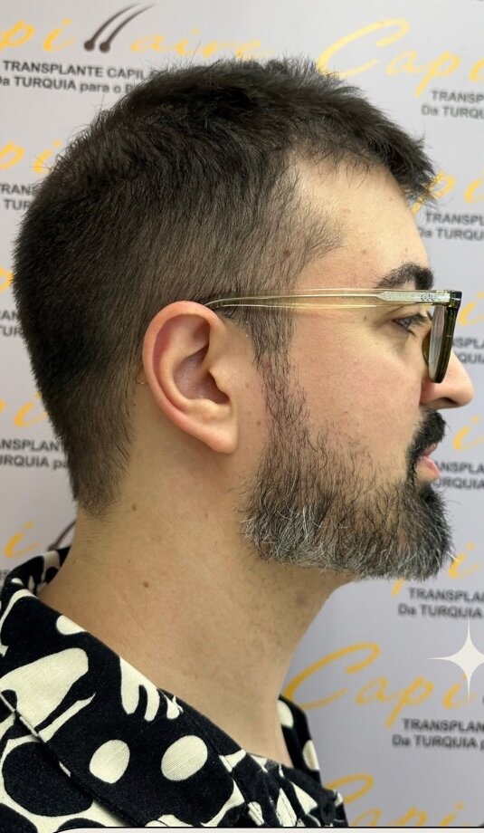 Antes: entradas e rarefação frontal