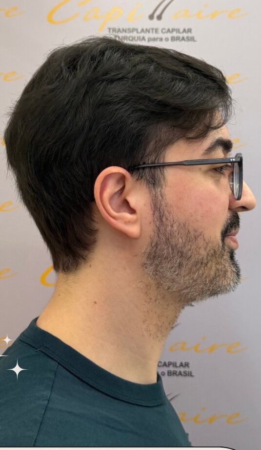 Depois de 12 meses: linha frontal reconstruída