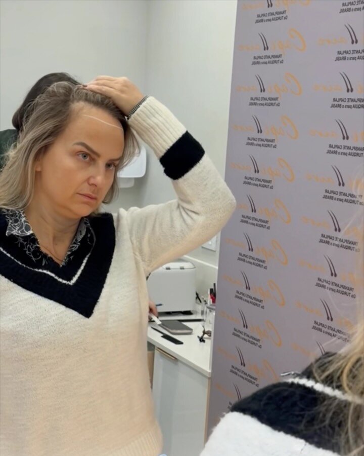 Paciente em avaliação para transplante capilar feminino