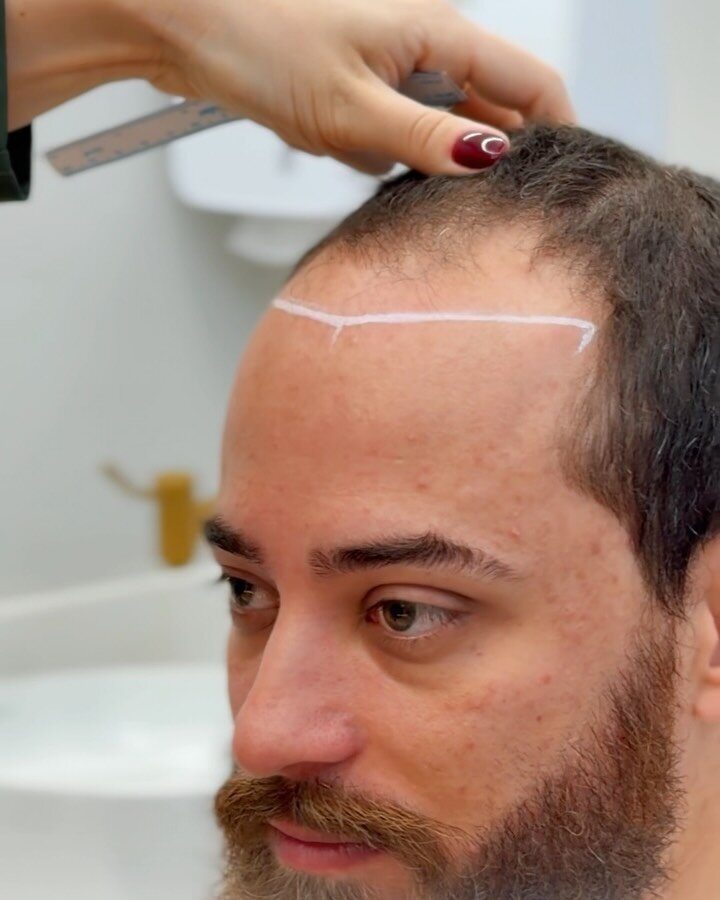 Desenho da linha frontal (hairline) antes do transplante