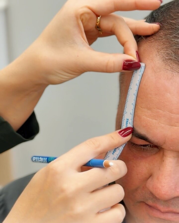 Medição com régua para o planejamento capilar